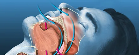 roxalito-apnoia-kyriakakis